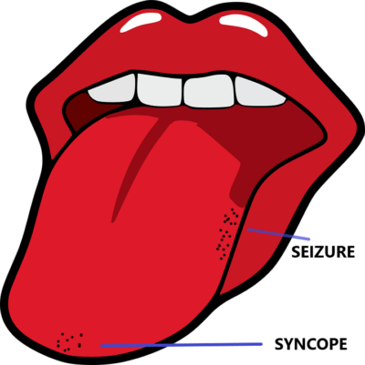 Tongue bite seizure